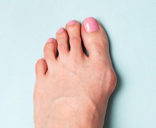 Big Toe Drifts Inward